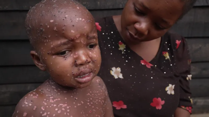 All of Nzigire Kanigo's children have contracted mpox, including two-year-old Ansima